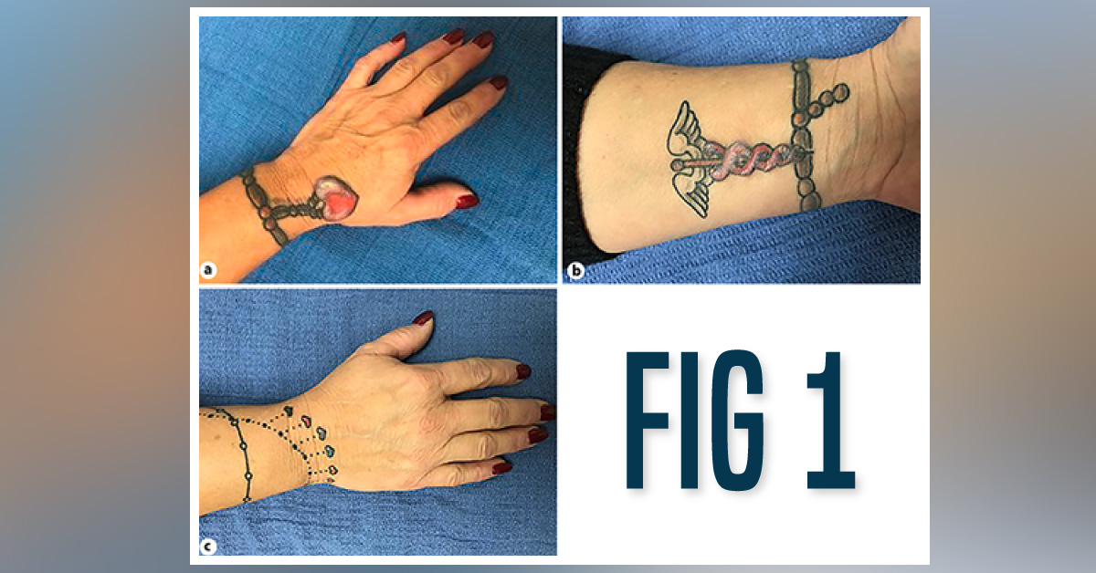 A  Rare Case of Tattoo Reaction